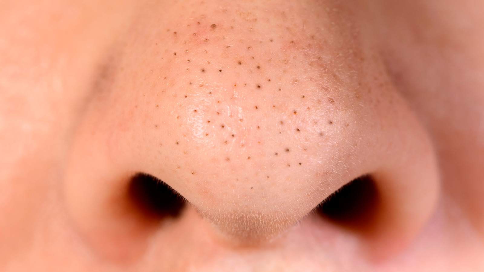 Here s What You Need To Know Before Removing Blackheads