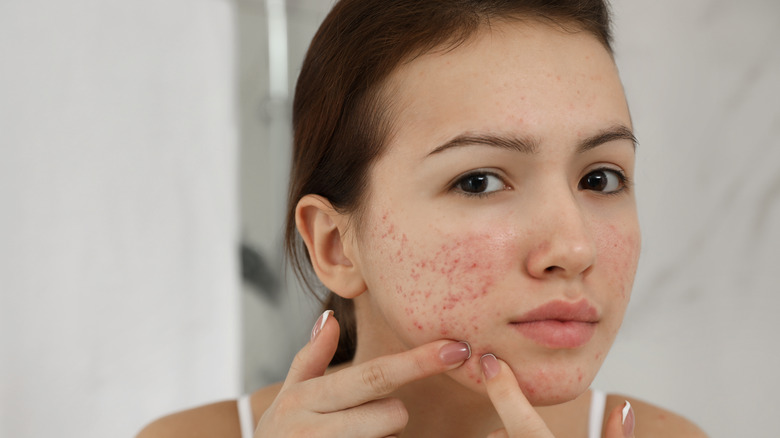 Woman with acne touching her face