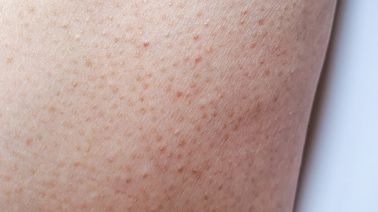 Here s Why You Have Little Bumps On Your Arms