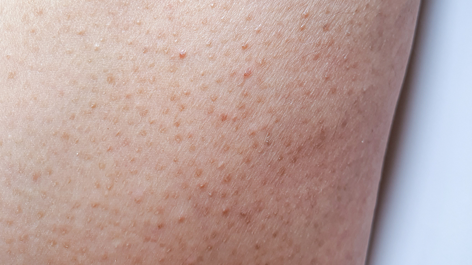 How To Get Rid Of White Bumps On Arms With Images Bum - vrogue.co