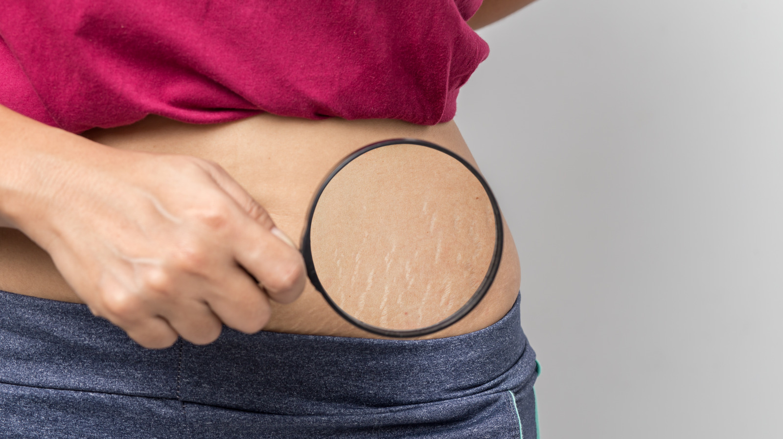 home-remedies-that-can-reduce-the-appearance-of-stretch-marks