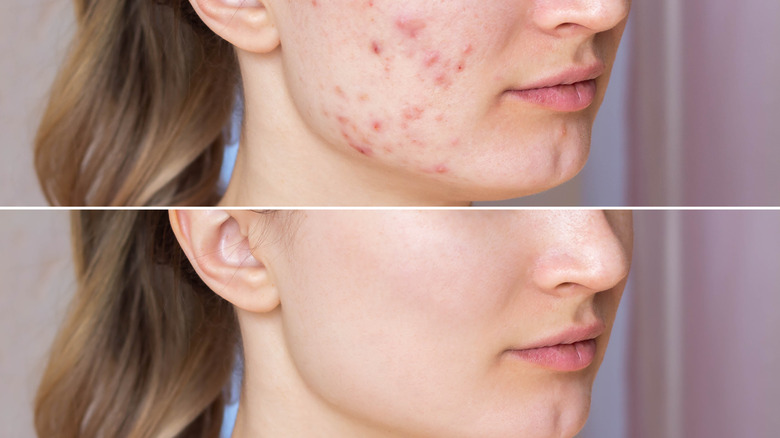 Pimples: before and after