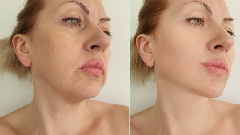 woman before and after treatments