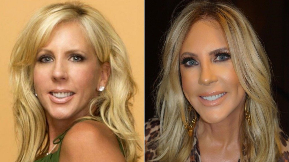 Real Housewife Vicki Gunvalson, before and after plastic surgery