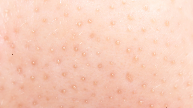 Blackheads on skin 