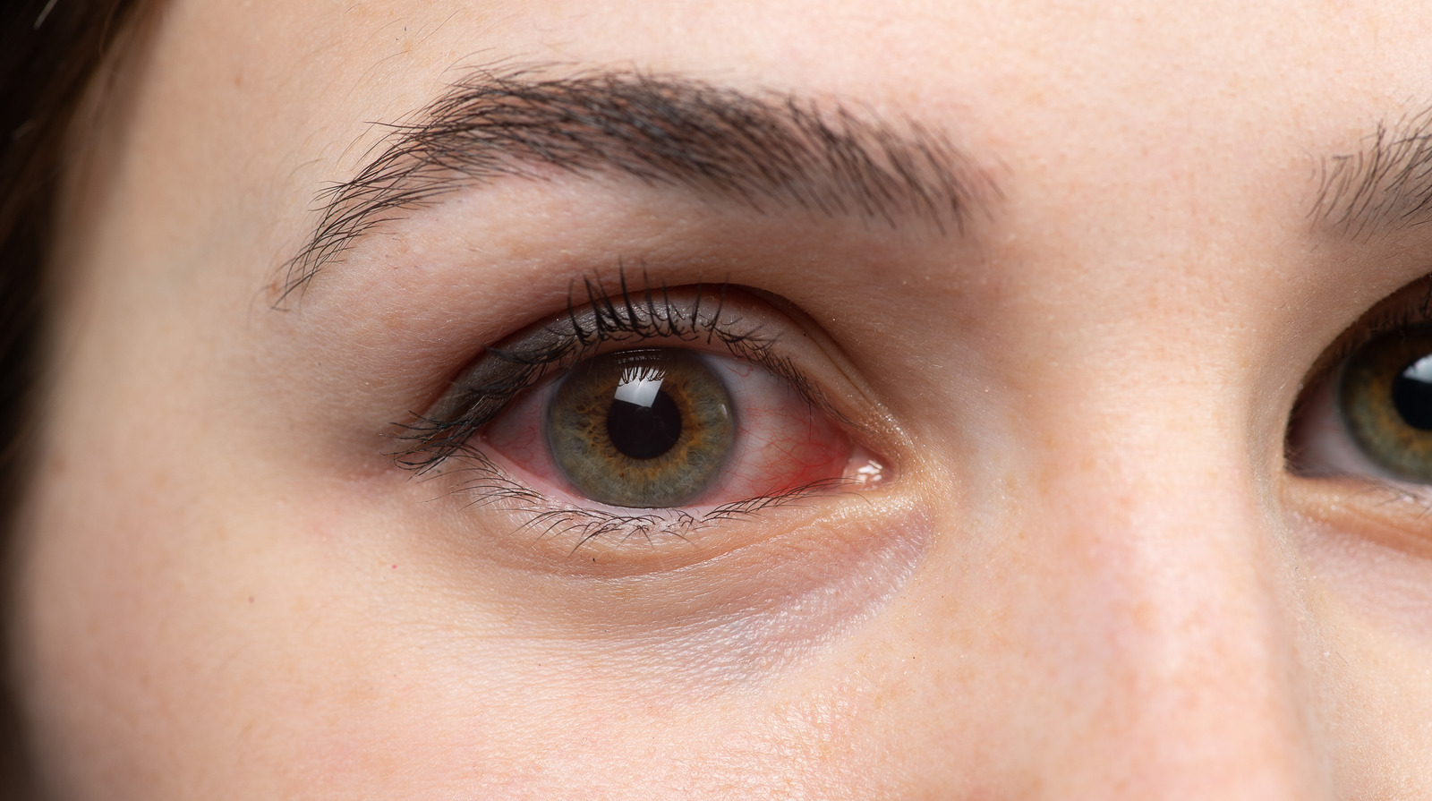 How To Treat Dry Bloodshot Eyes