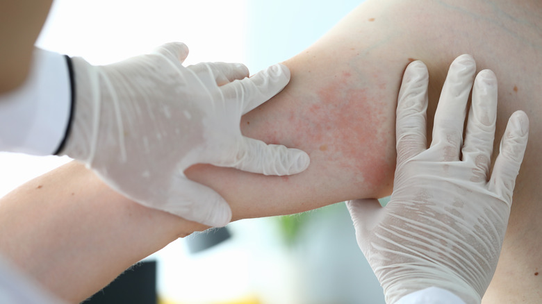 Doctor looking at hives