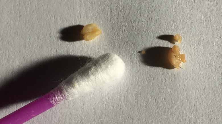 Tonsil stones with cotton swab nearby