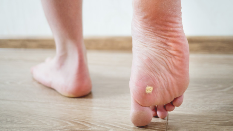 Warts on a foot