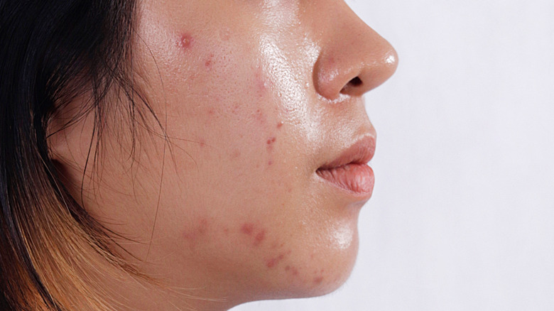 Close up of chin acne