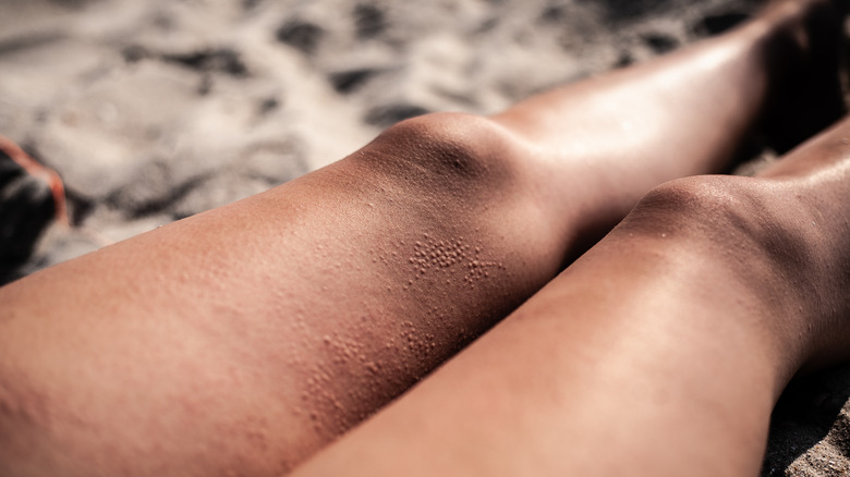 woman's legs with sand allergy reaction