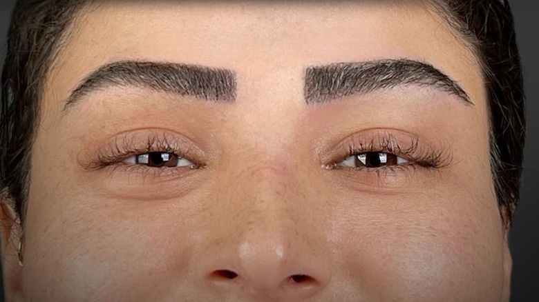 Eyebrow transplant patient