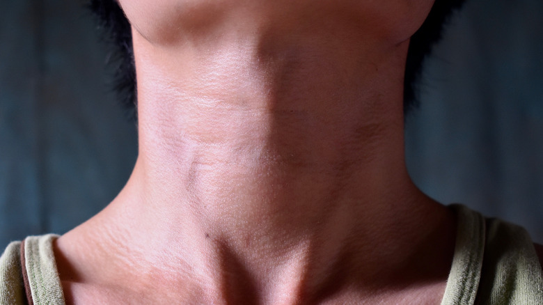 Woman with a thyroid tumor