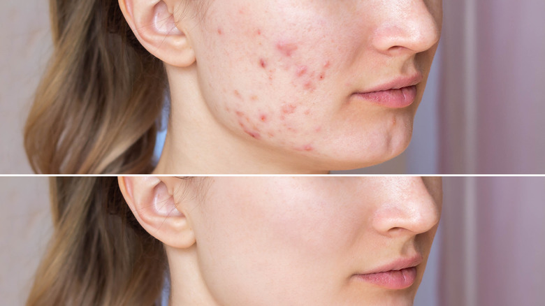 Acne, before and after