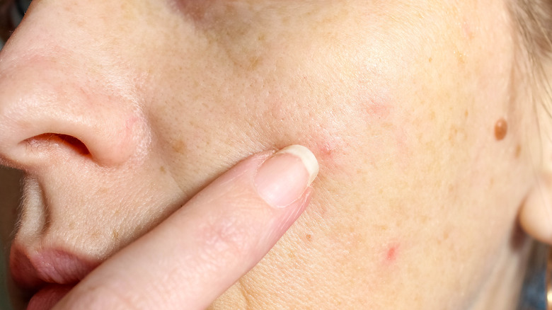 Older woman with pimples