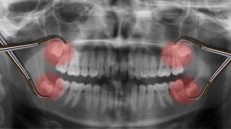 wisdom teeth human body parts wisdom teeth