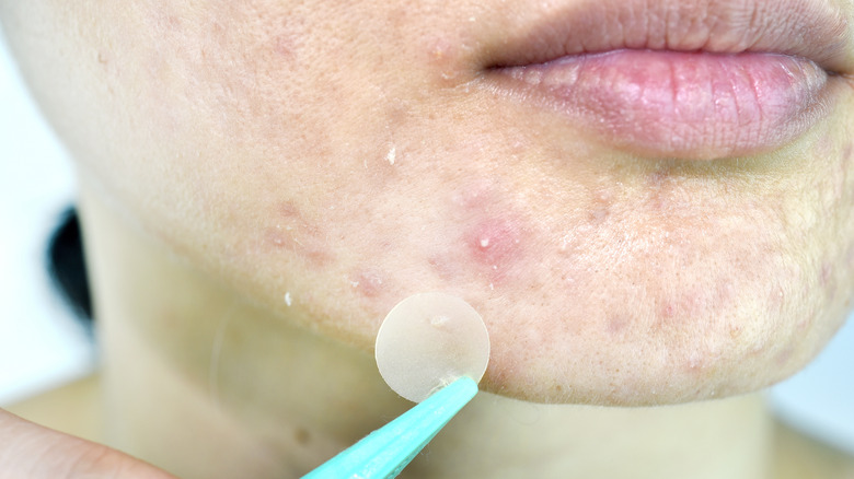 woman holding pimple patch against face