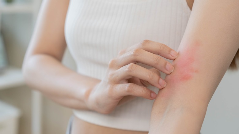 Closeup atopic dermatitis on arm