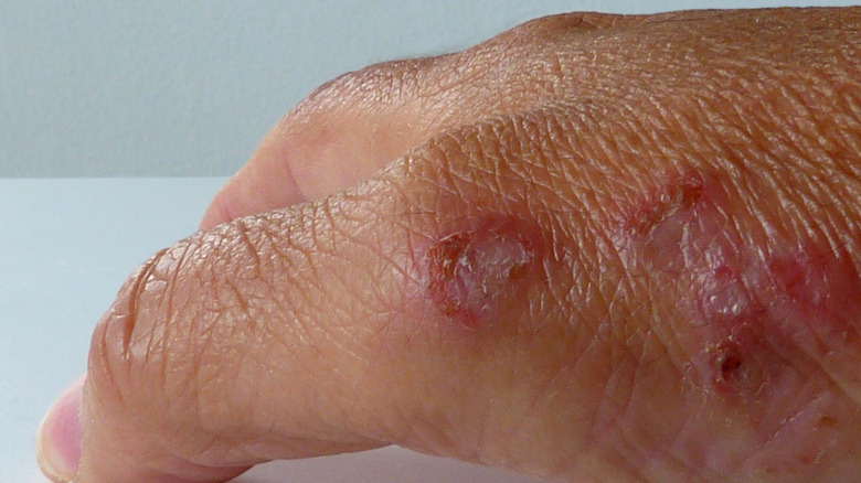 Discoid eczema closeup