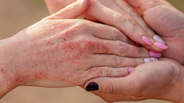 Dyshidrotic eczema on hands