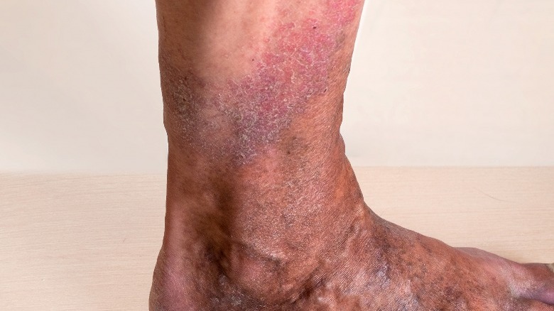 Varicose eczema closeup