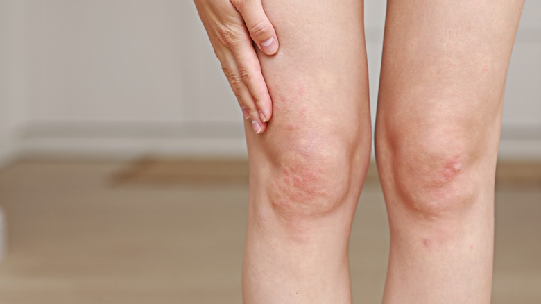 if-you-get-acne-on-your-legs-this-could-be-why