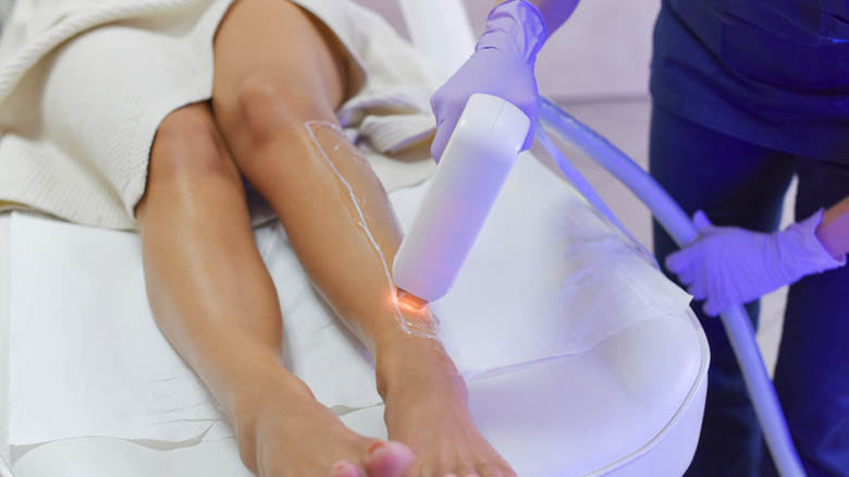 Laser hair removal on legs