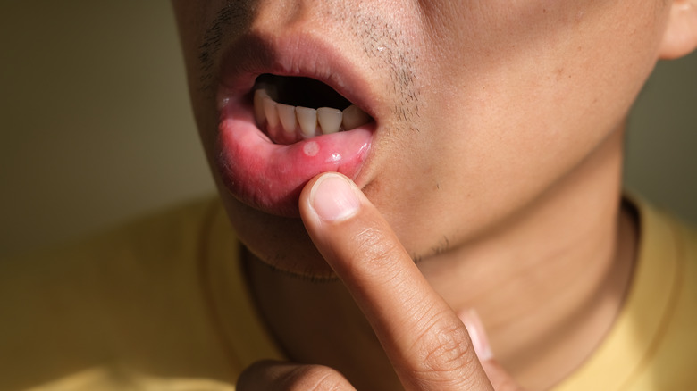 man pointing to sore on lip