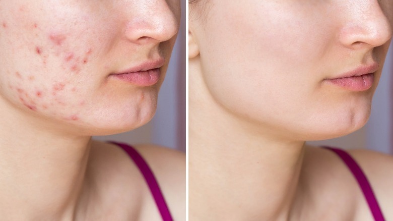 Before and after pictures of woman with acne