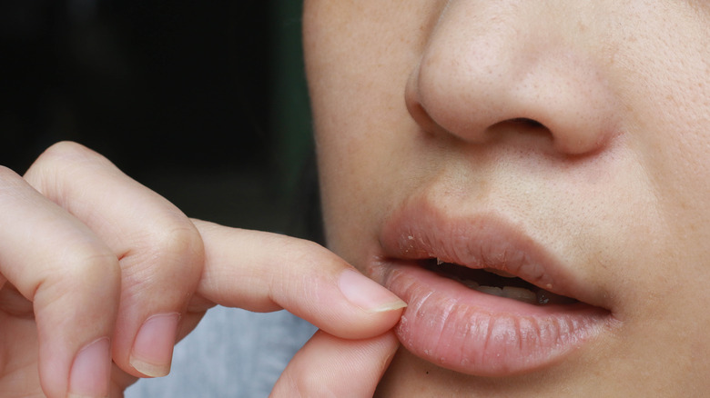 Woman touching her dry, chapped lips