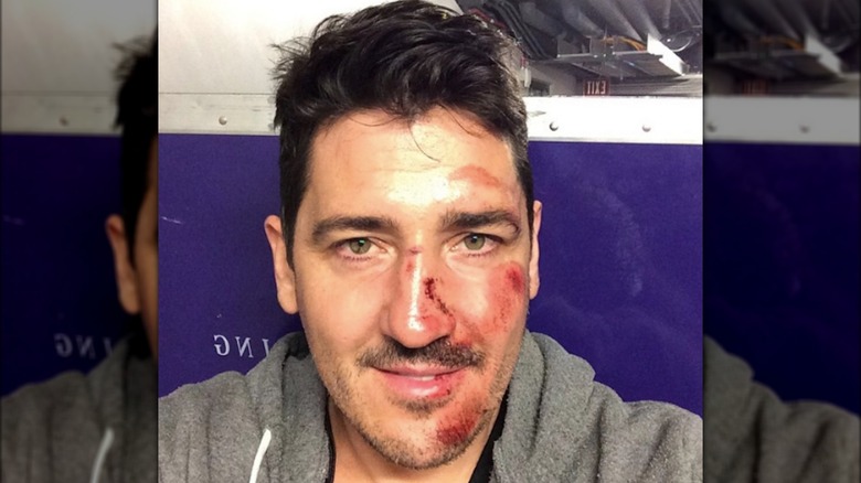 Jonathan Knight displaying injured face