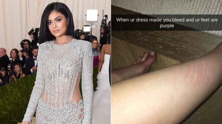 Kylie Jenner bruised after 2016 Met Gala