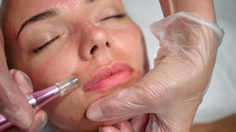 woman receiving microneedling treatment