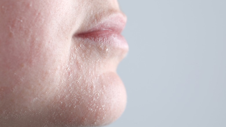 Woman's chin with dry skin