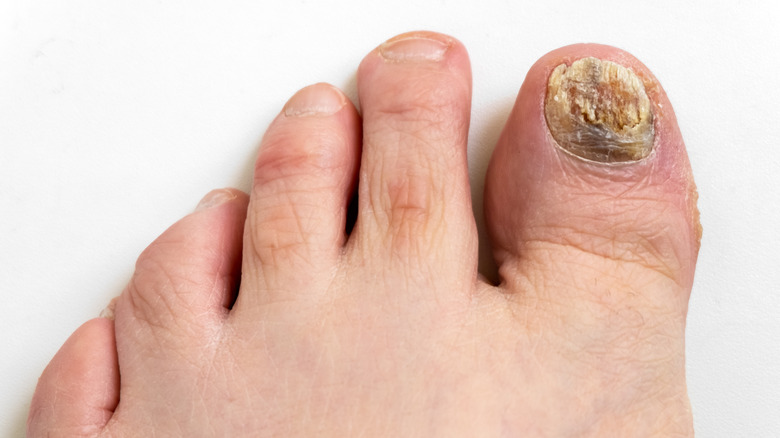 Toenail with nail fungus infection