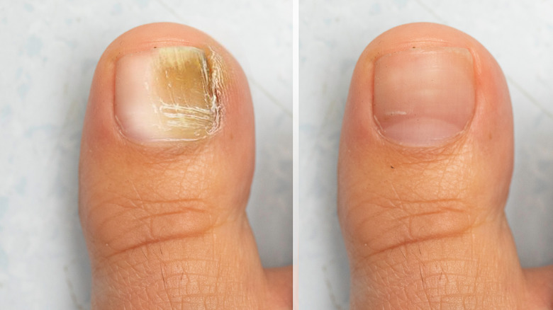 Toe before and after fungus treatment