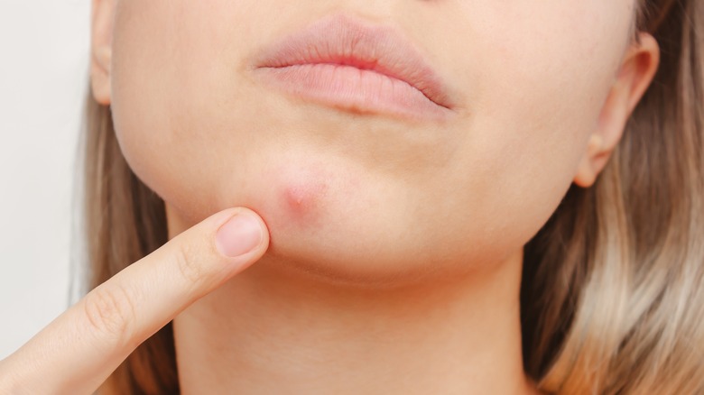 woman points at pimple on chin