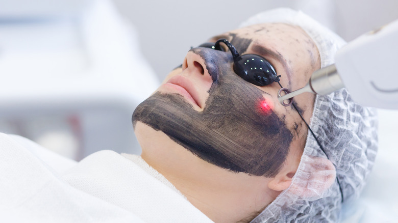 laser carbon peel facial