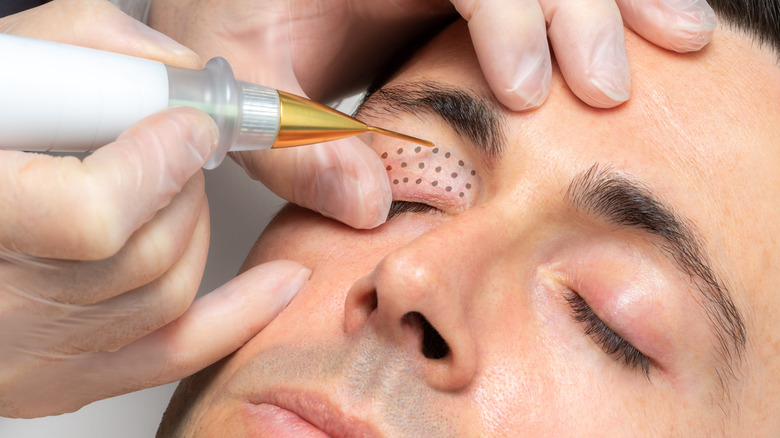 A man receiving plasma pen treatment on the eyes 