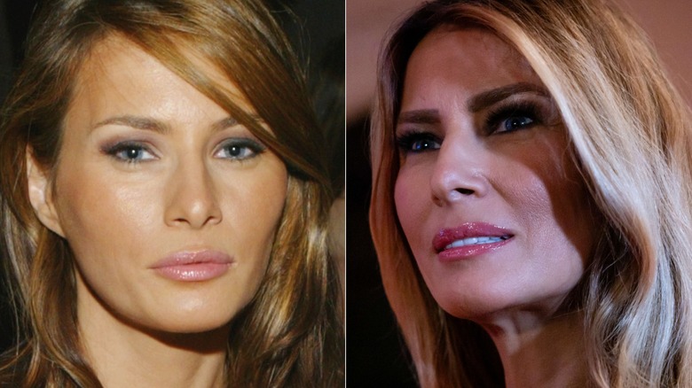 A comparison of Melania Trump before and after surgery