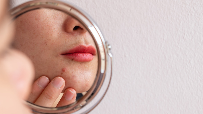 Woman with acne looking in mirror