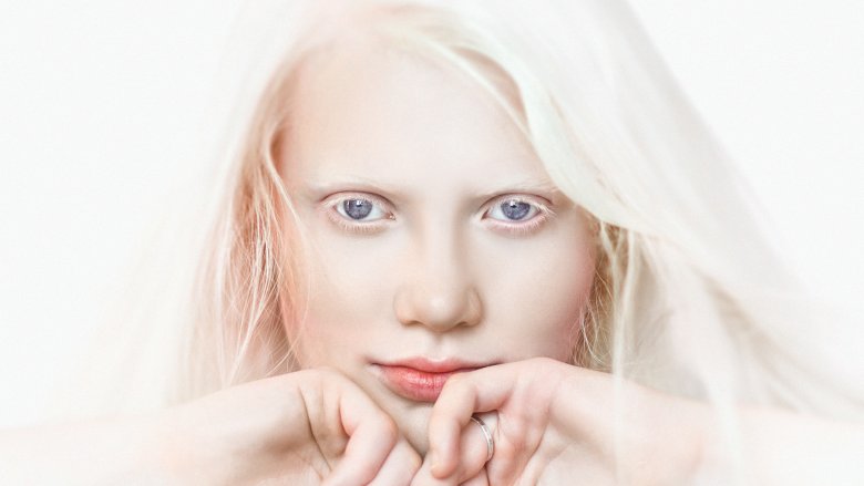 Woman with albinism, a rare body feature