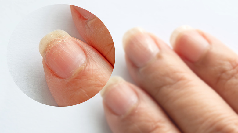 Closeup of brittle nails