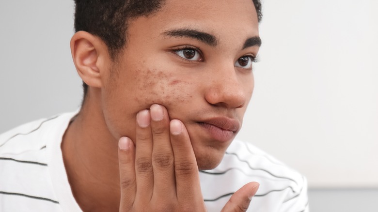 boy touching acne on face