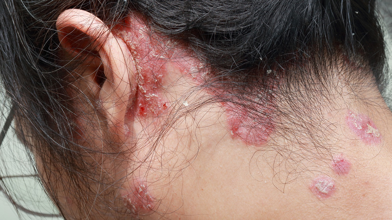 woman with scalp psoriasis 