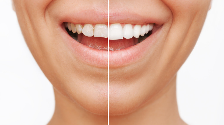 Split image of before and after veneers