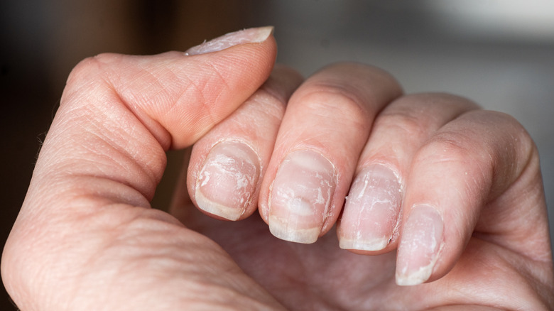 Peeling fingernails 