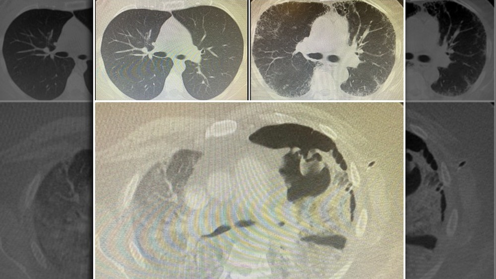 Collage of CT scans showing healthy lungs, smoker's lungs, and Covid lungs