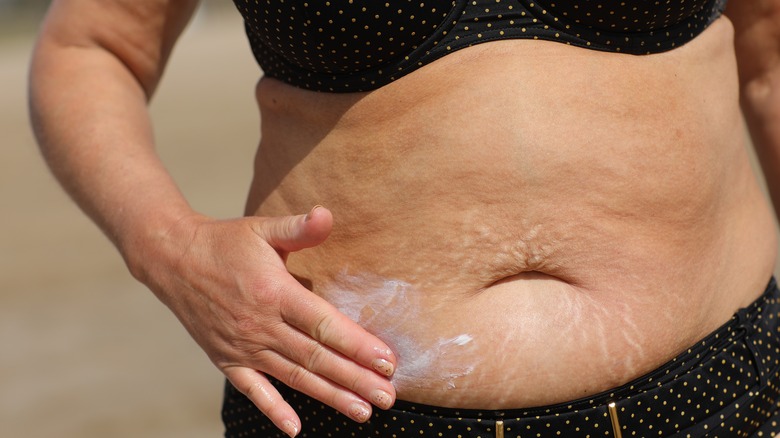 Woman applying cream to her stretch marks