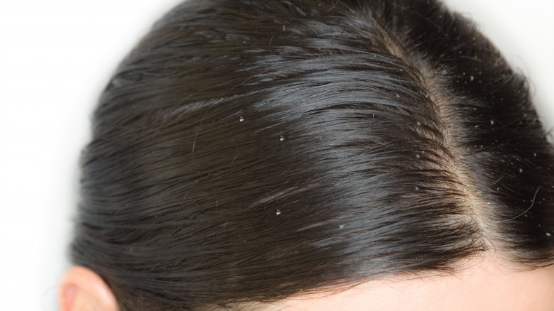 dandruff scalp